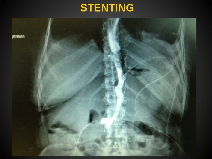  STENTING 