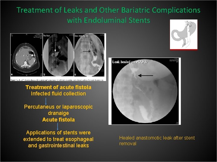 Treatment of Leaks and Other Bariatric Complications with Endoluminal Stents Treatment of acute fistola