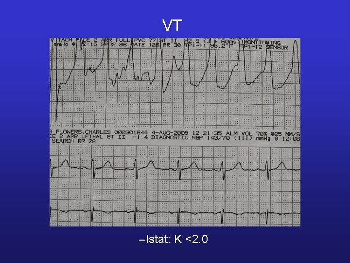 VT –Istat: K <2. 0 
