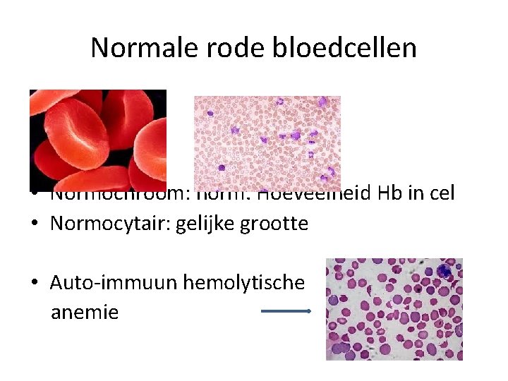 Normale rode bloedcellen • Normochroom: norm. Hoeveelheid Hb in cel • Normocytair: gelijke grootte