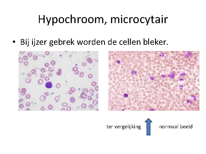 Hypochroom, microcytair • Bij ijzer gebrek worden de cellen bleker. ter vergelijking normaal beeld