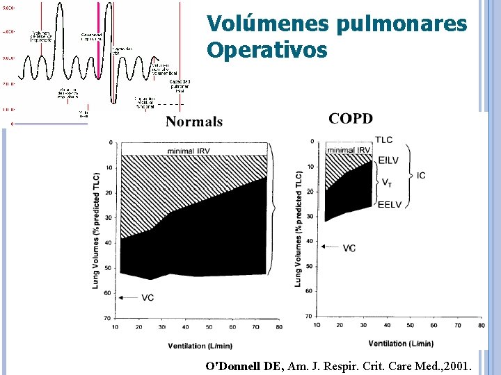 Volúmenes pulmonares Operativos O'Donnell DE, Am. J. Respir. Crit. Care Med. , 2001. 