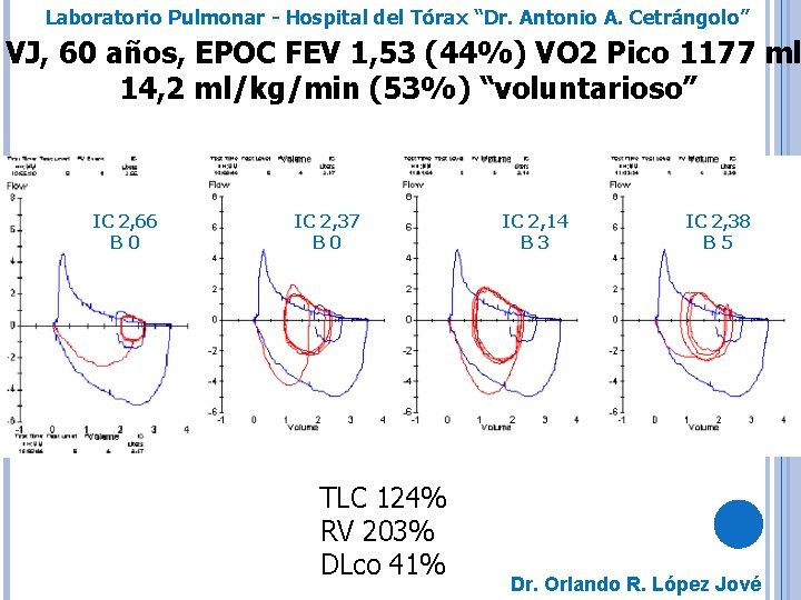 Laboratorio Pulmonar - Hospital del Tórax “Dr. Antonio A. Cetrángolo” VJ, 60 años, EPOC