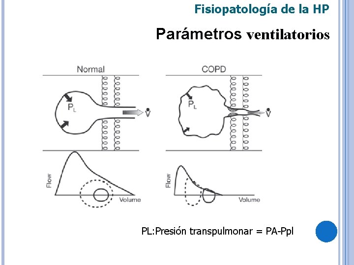 Fisiopatología de la HP Parámetros ventilatorios PL: Presión transpulmonar = PA-Ppl 