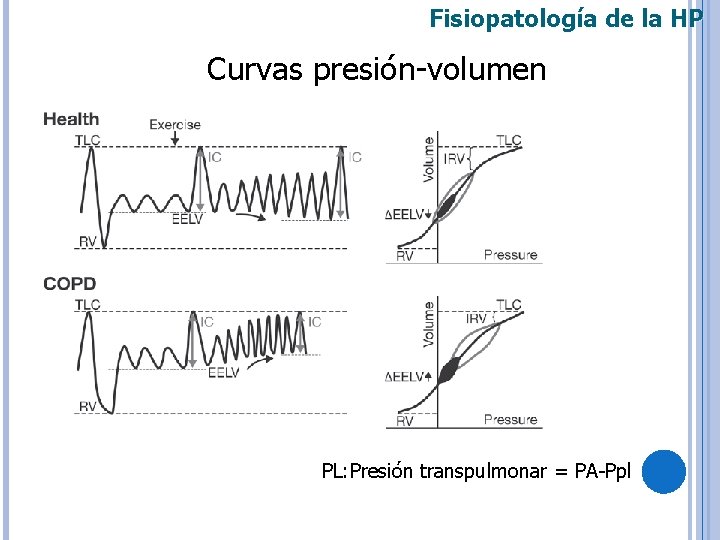 Fisiopatología de la HP Curvas presión-volumen PL: Presión transpulmonar = PA-Ppl 