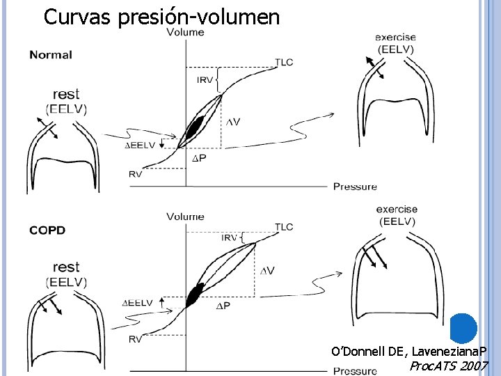 Curvas presión-volumen O’Donnell DE, Laveneziana. P Proc. ATS 2007 