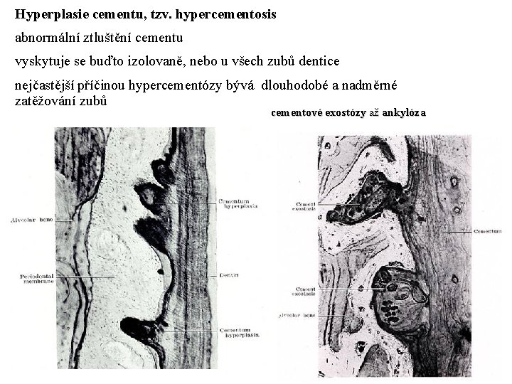 Hyperplasie cementu, tzv. hypercementosis abnormální ztluštění cementu vyskytuje se buďto izolovaně, nebo u všech