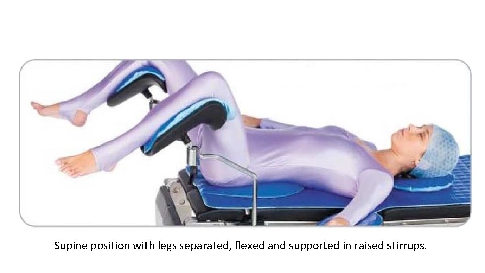 Supine position with legs separated, flexed and supported in raised stirrups. 