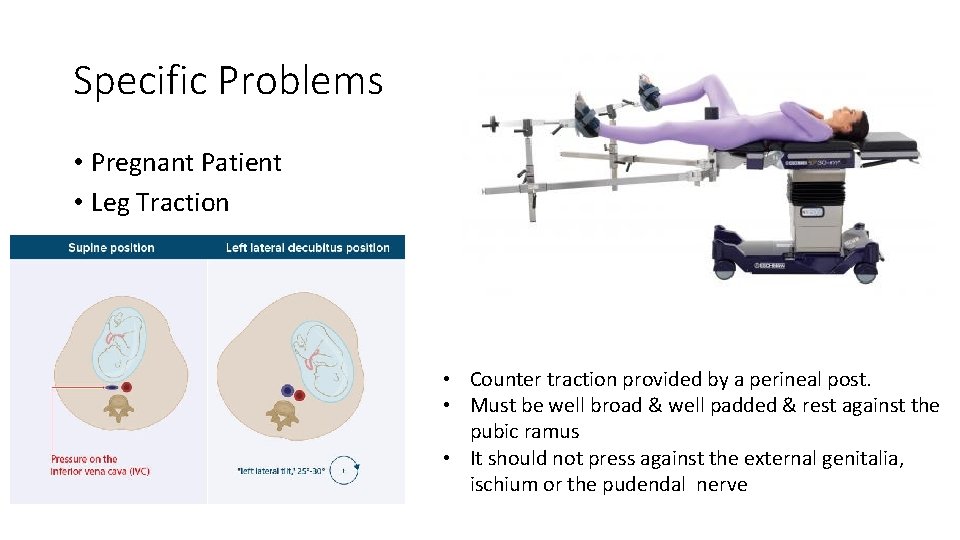 Specific Problems • Pregnant Patient • Leg Traction • Counter traction provided by a