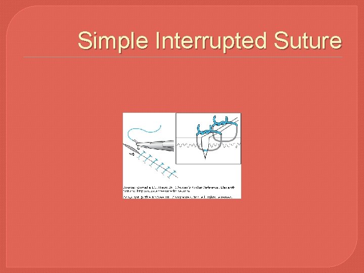 Simple Interrupted Suture 