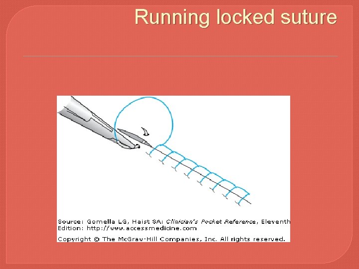 Running locked suture 