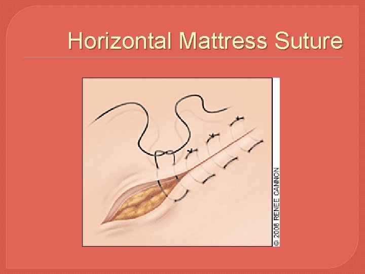 Horizontal Mattress Suture 