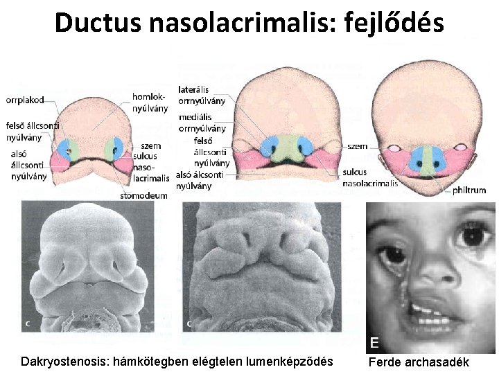 Ductus nasolacrimalis: fejlődés Dakryostenosis: hámkötegben elégtelen lumenképződés Ferde archasadék 