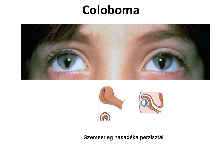 Coloboma Szemserleg hasadéka perzisztál 