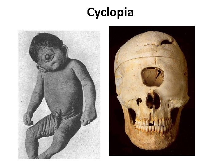 Cyclopia 