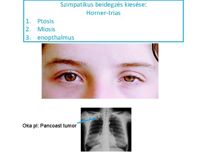 Szimpatikus beidegzés kiesése: Horner-trias 1. Ptosis 2. Miosis 3. enopthalmus Oka pl: Pancoast tumor