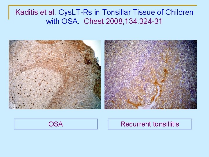 Kaditis et al. Cys. LT-Rs in Tonsillar Tissue of Children with OSA. Chest 2008;