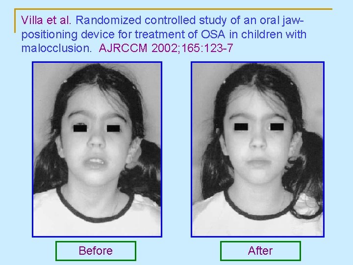 Villa et al. Randomized controlled study of an oral jawpositioning device for treatment of