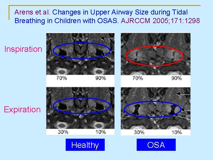 Arens et al. Changes in Upper Airway Size during Tidal Breathing in Children with