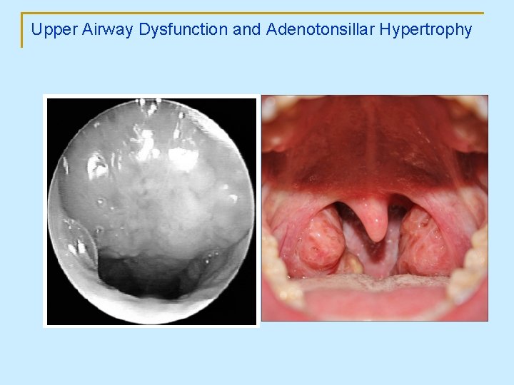 Upper Airway Dysfunction and Adenotonsillar Hypertrophy 