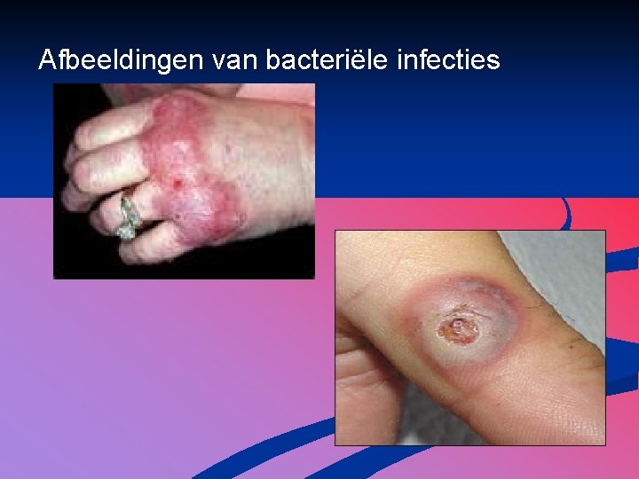 Afbeeldingen van bacteriële infecties 
