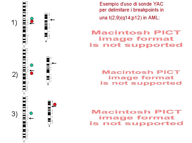 Esempio d’uso di sonde YAC per delimitare i breakpoints in 1) 2) 3) una