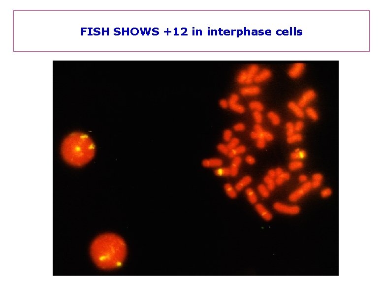 FISH SHOWS +12 in interphase cells 