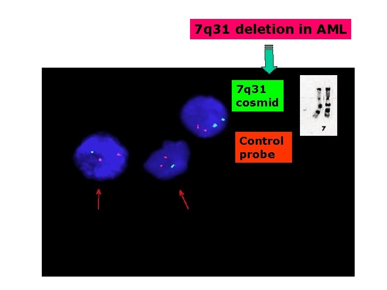 7 q 31 deletion in AML 7 q 31 cosmid Control probe 