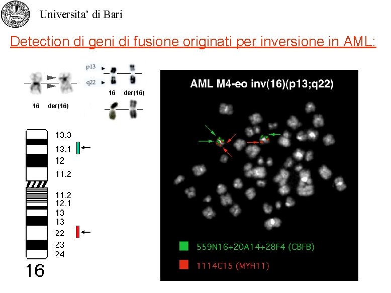 Universita’ di Bari Detection di geni di fusione originati per inversione in AML: 
