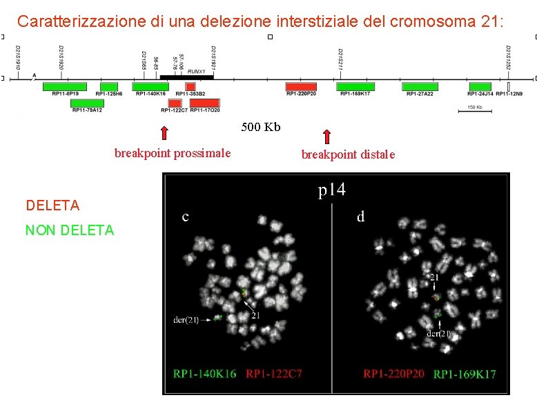 Caratterizzazione di una delezione interstiziale del cromosoma 21: 500 Kb breakpoint prossimale DELETA NON