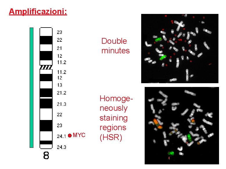 Amplificazioni: Double minutes MYC Homogeneously staining regions (HSR) 