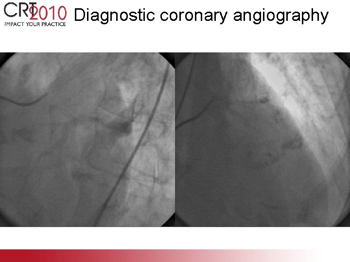 Diagnostic coronary angiography 