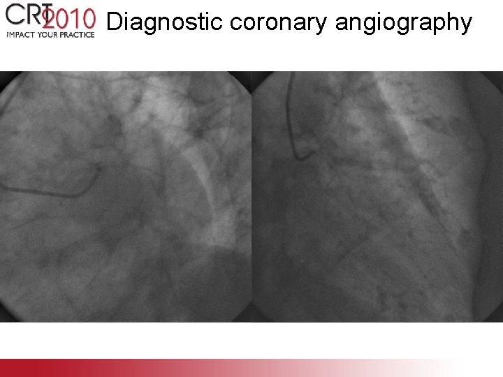 Diagnostic coronary angiography 