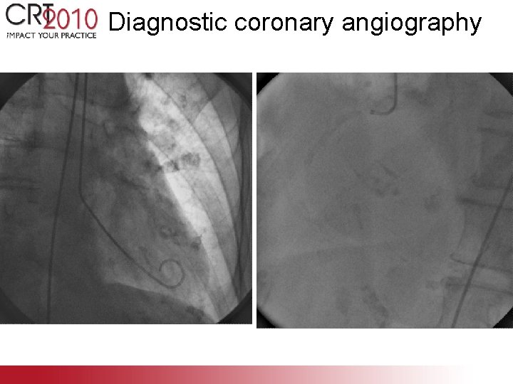 Diagnostic coronary angiography 