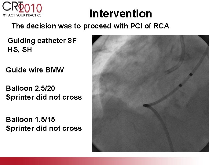 Intervention The decision was to proceed with PCI of RCA Guiding catheter 8 F