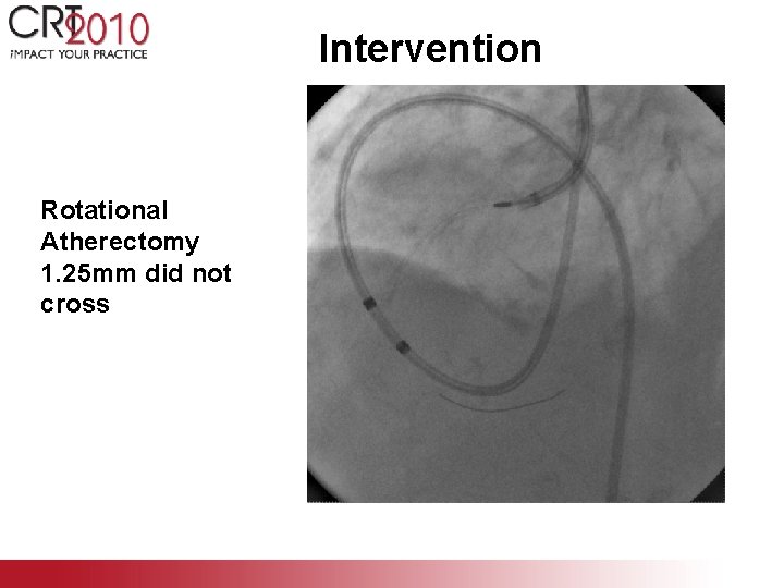 Intervention Rotational Atherectomy 1. 25 mm did not cross 