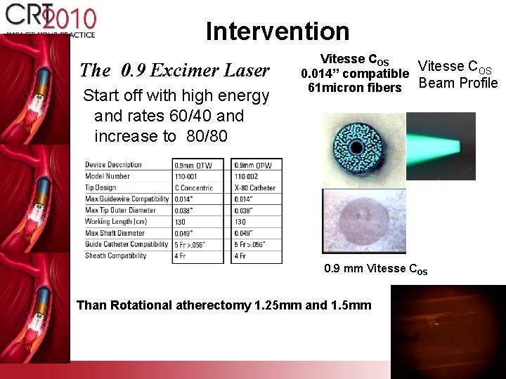 Intervention The 0. 9 Excimer Laser Start off with high energy and rates 60/40
