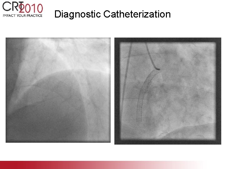 Diagnostic Catheterization 