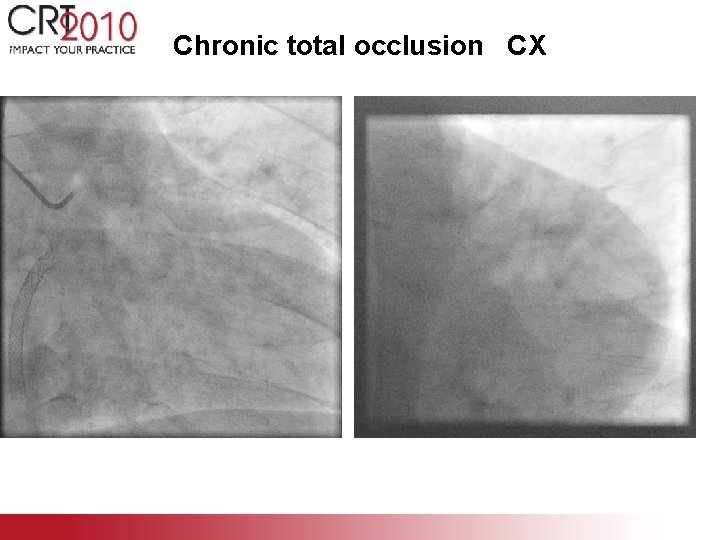 Chronic total occlusion CX 