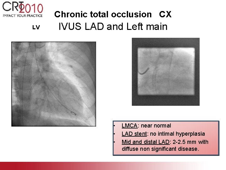 Chronic total occlusion CX LV IVUS LAD and Left main • • • LMCA: