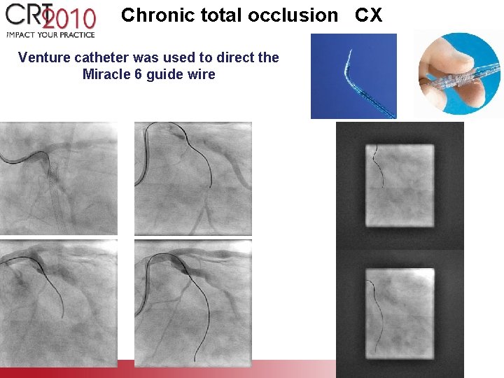 Chronic total occlusion CX Venture catheter was used to direct the Miracle 6 guide