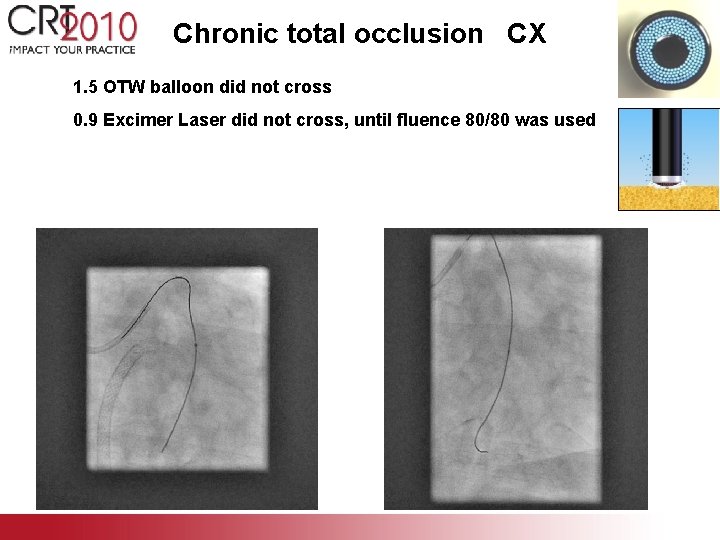 Chronic total occlusion CX 1. 5 OTW balloon did not cross 0. 9 Excimer