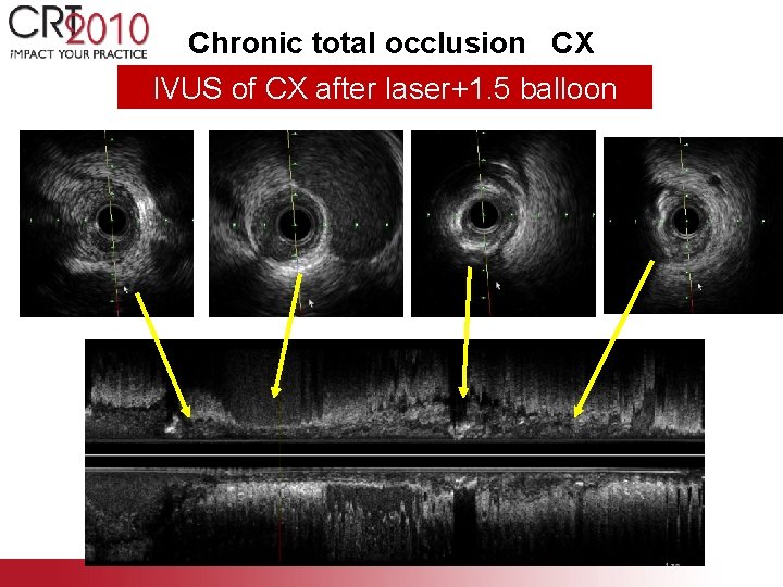 Chronic total occlusion CX IVUS of CX after laser+1. 5 balloon 