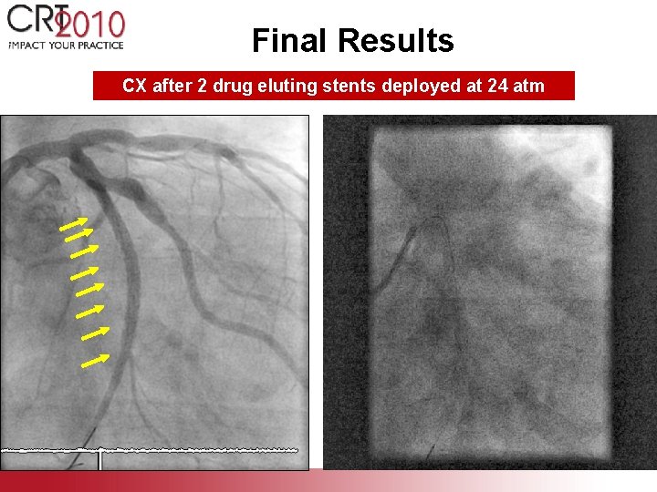 Final Results CX after 2 drug eluting stents deployed at 24 atm 