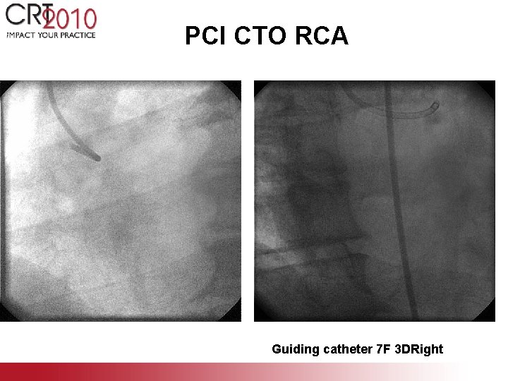 PCI CTO RCA Guiding catheter 7 F 3 DRight 