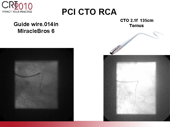PCI CTO RCA Guide wire. 014 in Miracle. Bros 6 CTO 2. 1 f