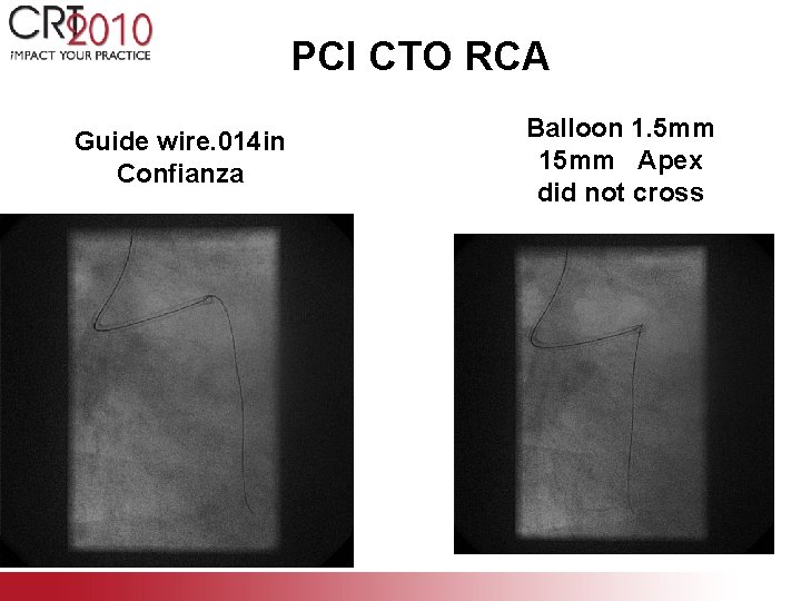 PCI CTO RCA Guide wire. 014 in Confianza Balloon 1. 5 mm 15 mm