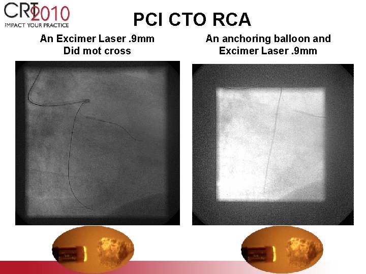 PCI CTO RCA An Excimer Laser. 9 mm Did mot cross An anchoring balloon