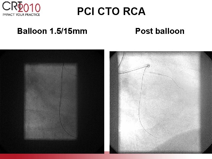 PCI CTO RCA Balloon 1. 5/15 mm Post balloon 