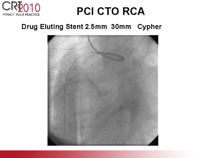 PCI CTO RCA Drug Eluting Stent 2. 5 mm 30 mm Cypher 